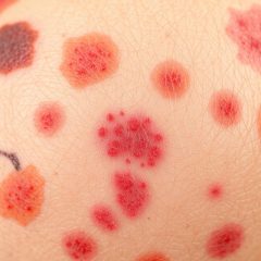 Jak rozpoznać i leczyć wysypkę u dorosłych? Choroby zakaźne i objawy